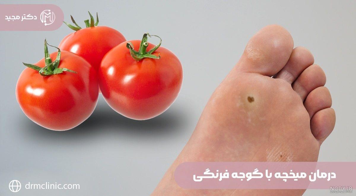 درمان میخچه با ساده ترین راهکارها در کوتاه ترین زمان درمان میخچه با ساده ترین راهکارها در کوتاه ترین زمان