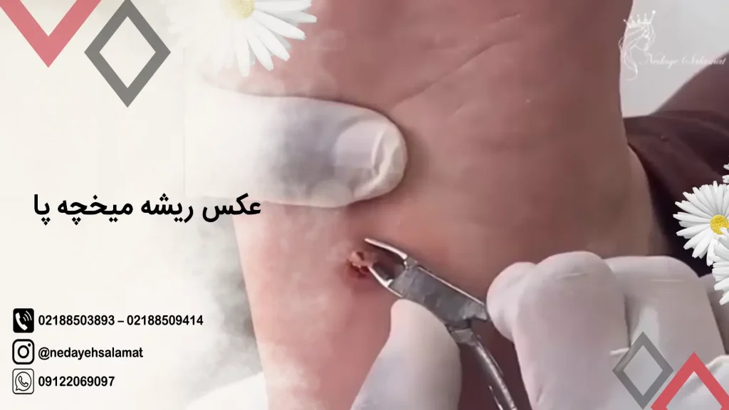 روش درمان میخچه با چسب میخچه + نکات مهم روش درمان میخچه با چسب میخچه + نکات مهم