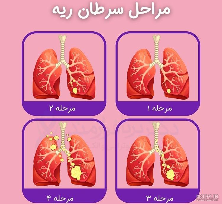 سرطان ریه | درمان سرطان ریه | پیشگیری از سرطان ریه | علائم سرطان ریه سرطان ریه | درمان سرطان ریه | پیشگیری از سرطان ریه | علائم سرطان ریه