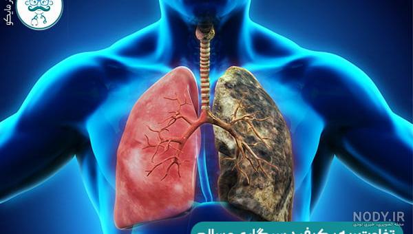 سرطان ریه، بررسی مهمترین علائم این سرطان خطرناک و راهنمای تشخیص سریع آن