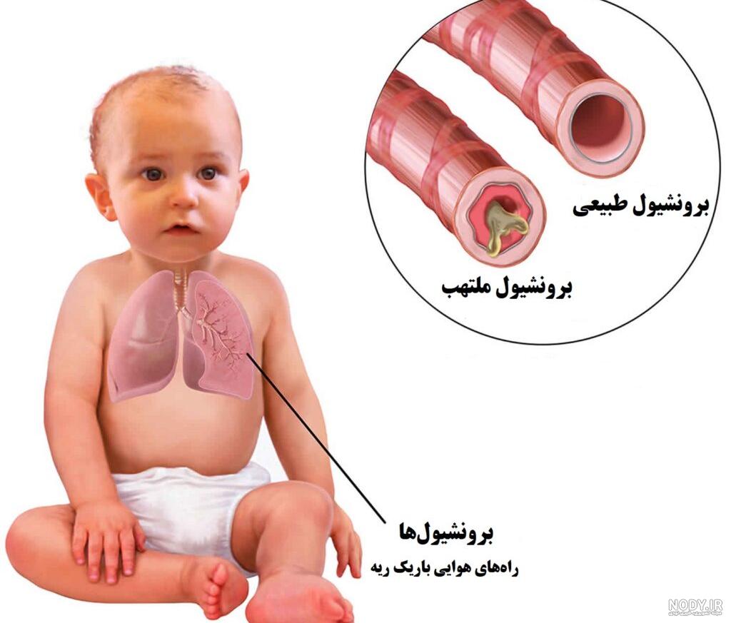 سندرم زجر تنفسی (HMD) چیست؟ و راه‌های درمان آن + نکات طلایی – آموزش پرستاری  با دکترمهدی حیدری
