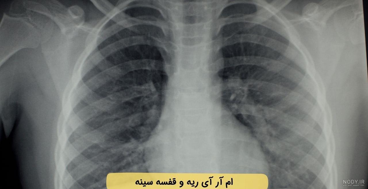 سونوگرافی ریه در کودکان و کاربرد آن - مرکز سونوگرافی طنین سونوگرافی ریه در کودکان و کاربرد آن - مرکز سونوگرافی طنین