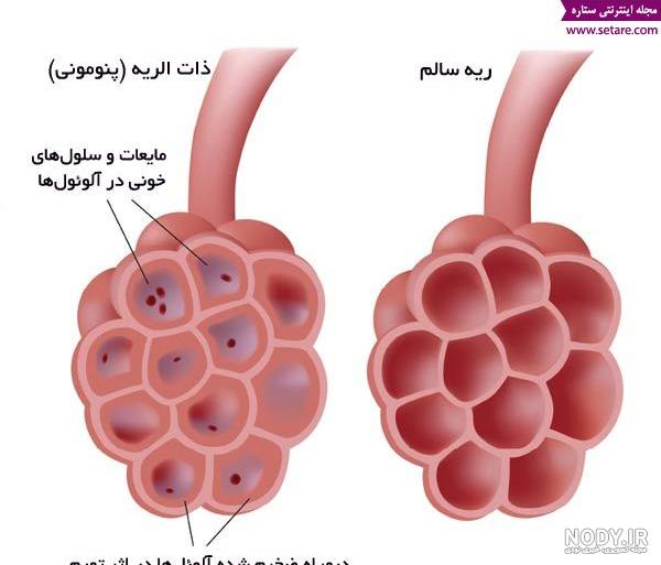 عفونت ریه چیست؟ علت، علائم و راه درمان - دکترمایکو عفونت ریه چیست؟ علت، علائم و راه درمان - دکترمایکو