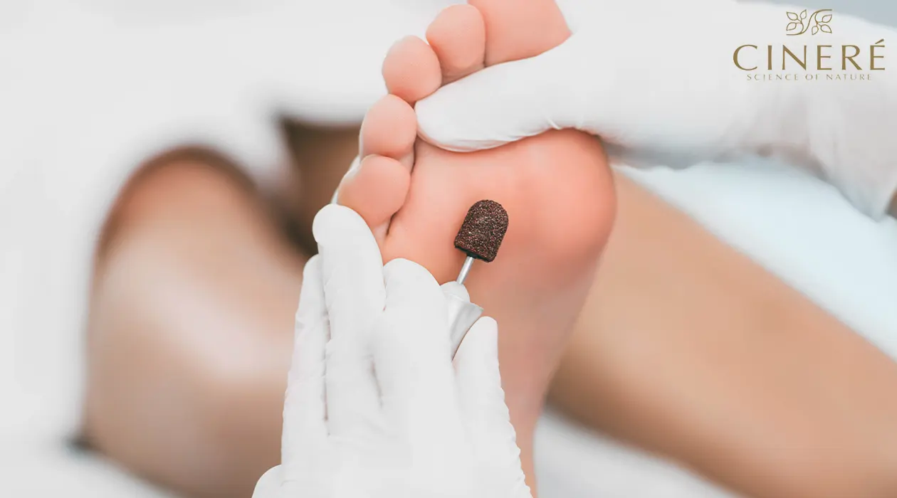 عکس از ریشه میخچه
