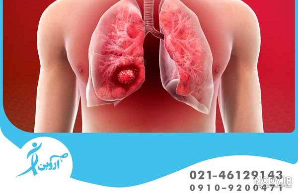 عکس رادیولوژی ریه سالم و ناسالم