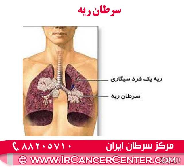 عکس رادیولوژی ریه سرطانی - عکس نودی عکس رادیولوژی ریه سرطانی - عکس نودی