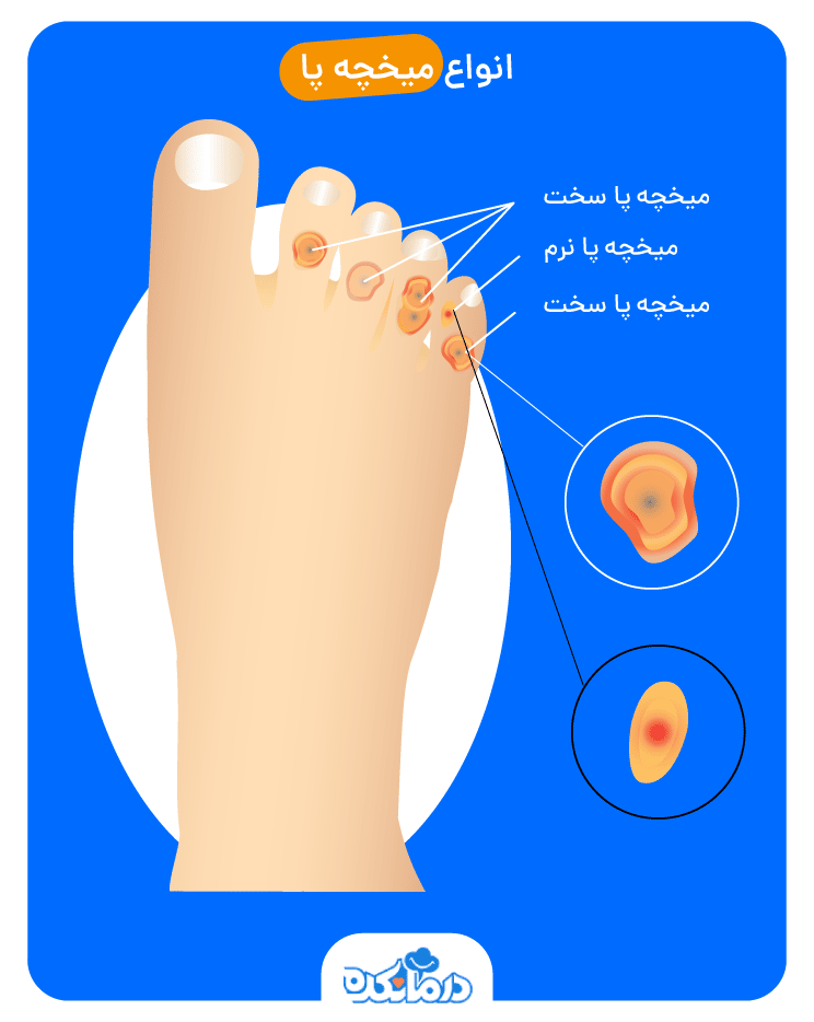 عکس ریشه میخچه