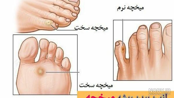 عکس ریشه میخچه انگشت دست