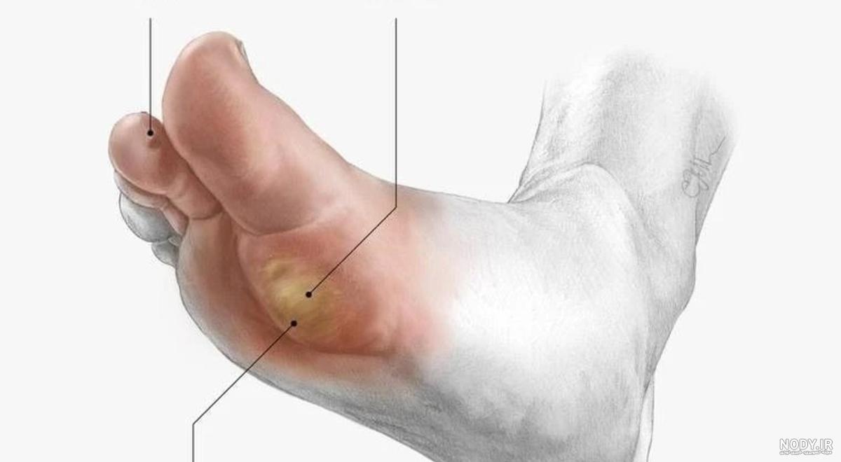 عکس ریشه میخچه پا