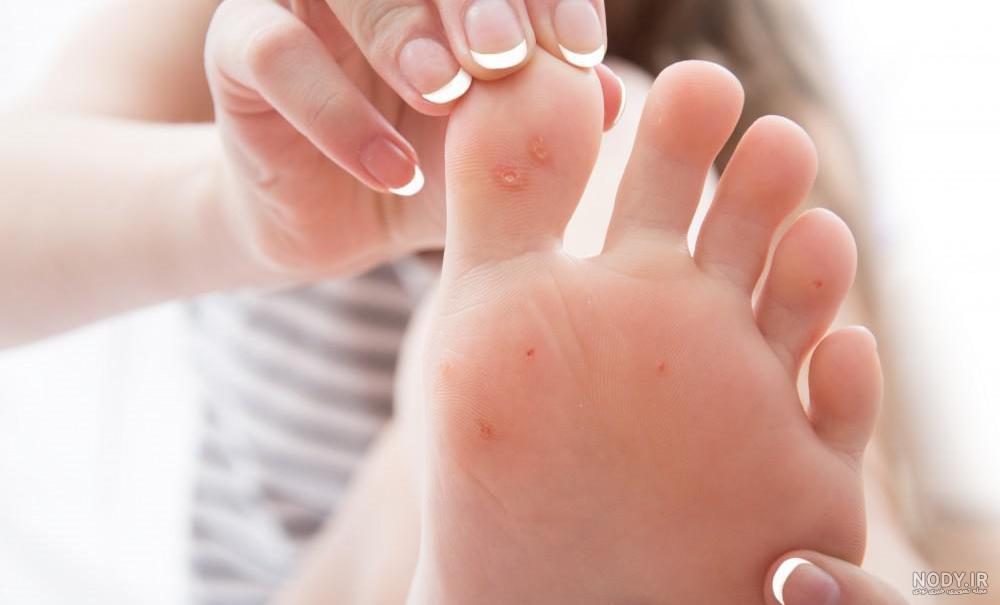 عکس ریشه میخچه پا - دکتر افسانه زرگنج فرد- بوتاکس صورت - 615-111-28-021