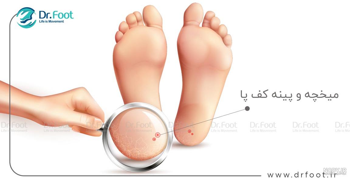 عکس ریشه میخچه پا نی نی سایت