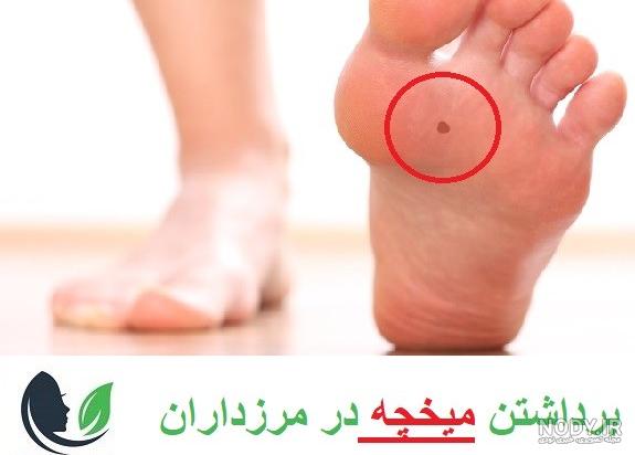 عکس ریشه میخچه کف پا