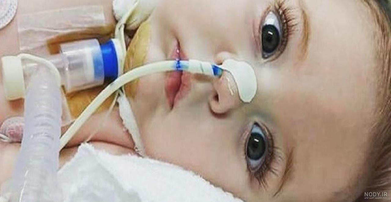عکس ریه درگیر کودک