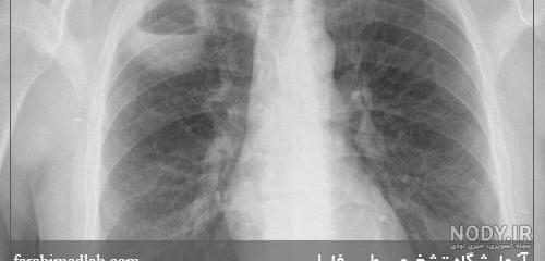 عکس ریه عفونت شده