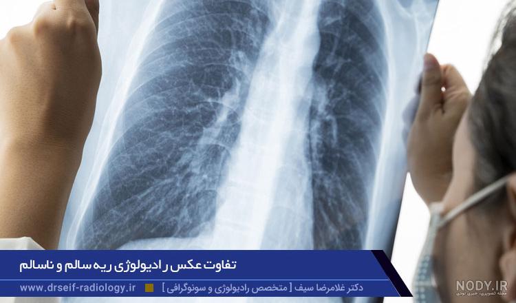 عکس ریه عفونتی کودک عکس ریه عفونتی کودک