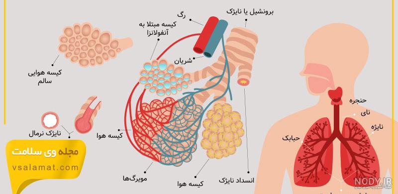 عکس ریه عفونی - عکس نودی عکس ریه عفونی - عکس نودی