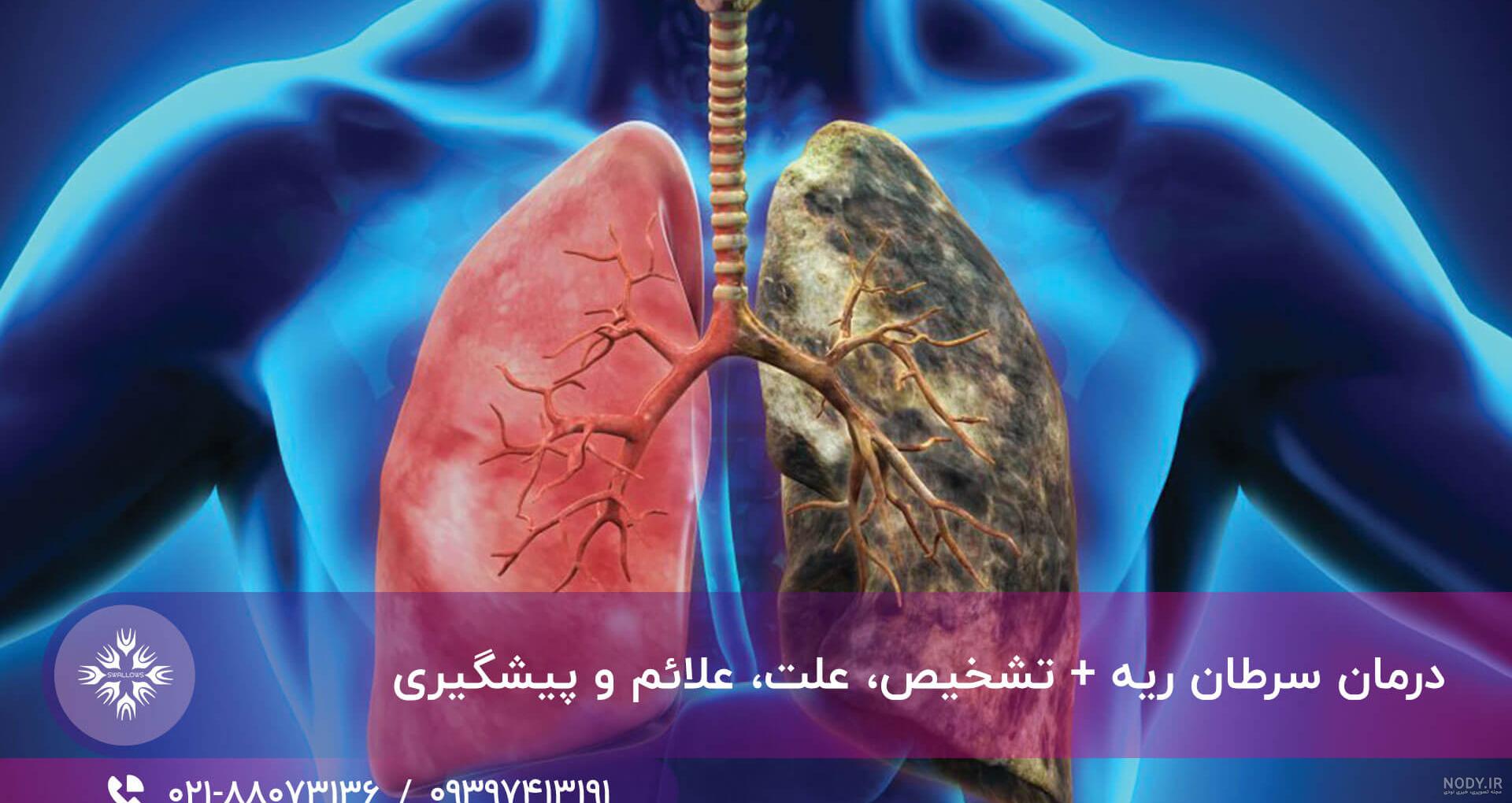 عکس ریه فرد سیگاری و سالم
