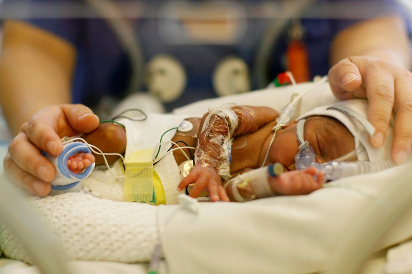 لوله تغذیه در بخش مراقبت‌های ویژه نوزادان (NICU) - دکتر فرشاد خسروی