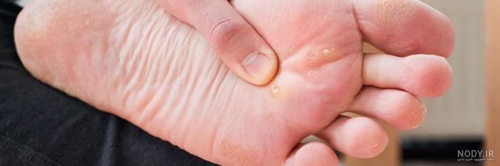 میخچه پا 😭😰 + عکس | تبادل نظر نی نی سایت میخچه پا 😭😰 + عکس | تبادل نظر نی نی سایت