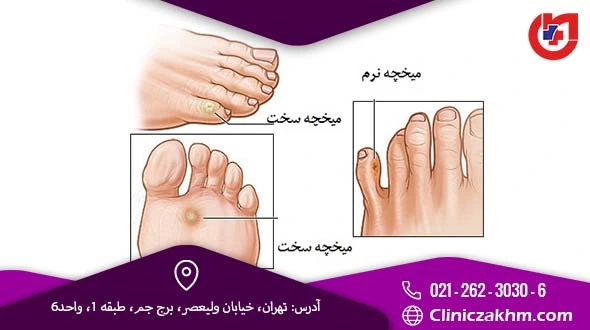 میخچه چیست | میخچه پا چیست | عکس ریشه میخچه پا | آیا میخچه خطرناک است