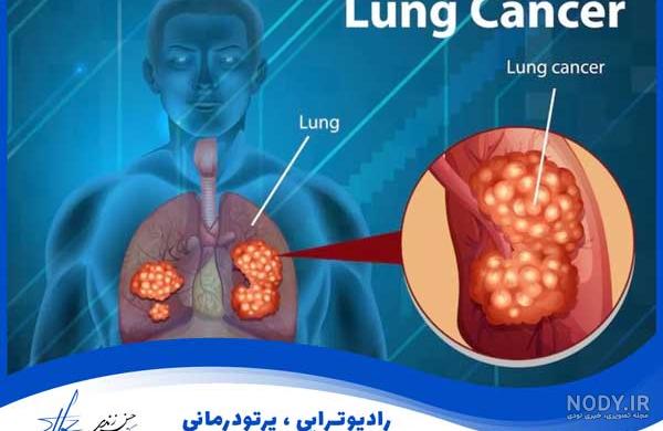 هوش مصنوعی سرطان ریه را تشخیص می‌دهد - خبرگزاری آنا