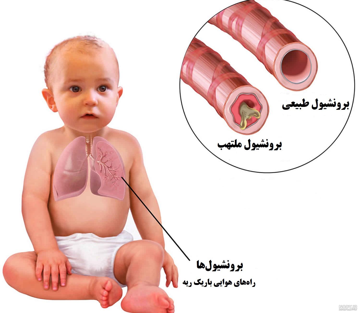 کیست ریه + انواع کیست ریه و درمان آن | مجله هومکا کیست ریه + انواع کیست ریه و درمان آن | مجله هومکا