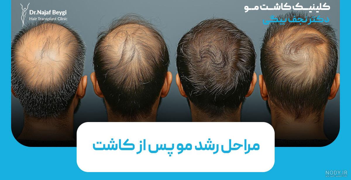 بهترین روش کاشت مو با تراکم بالا | فیلم و عکس کاشت مو طبیعی