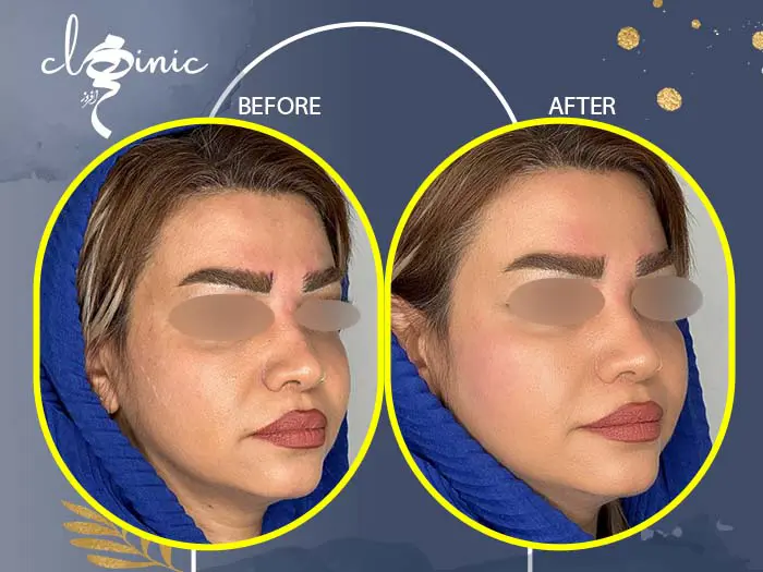 تزریق ژل به گونه چگونه است؟ آشنایی با ماندگاری تزریق ژل گونه – کلینیک زیبایی دکتر سعید کاظمی تزریق ژل به گونه چگونه است؟ آشنایی با ماندگاری تزریق ژل گونه – کلینیک زیبایی دکتر سعید کاظمی