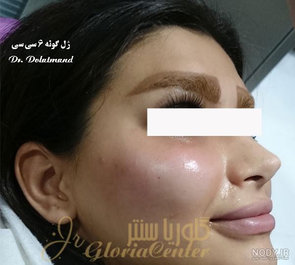 تزریق ژل گونه - راهکاری موثر جهت افزایش جذابیت چهره تزریق ژل گونه - راهکاری موثر جهت افزایش جذابیت چهره
