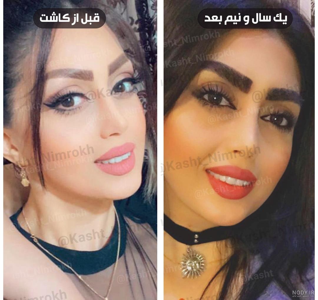 تصاویر قبل و بعد از کاشت ابرو - کلینیک کاشت مو VIP | کلینیک vipkasht | وی آی پی کاشت تصاویر قبل و بعد از کاشت ابرو - کلینیک کاشت مو VIP | کلینیک vipkasht | وی آی پی کاشت