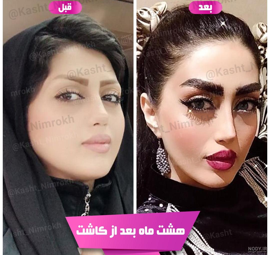 تصاویر قبل و بعد از کاشت ابرو - کلینیک کاشت مو VIP | کلینیک vipkasht | وی آی پی کاشت تصاویر قبل و بعد از کاشت ابرو - کلینیک کاشت مو VIP | کلینیک vipkasht | وی آی پی کاشت