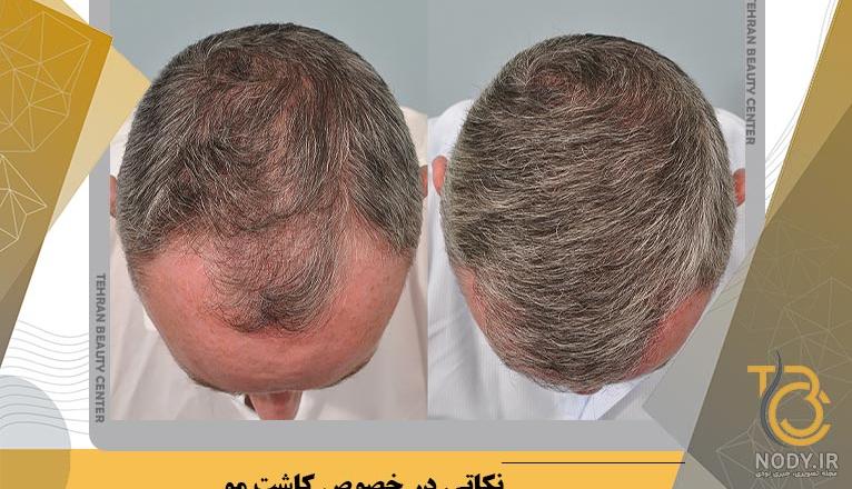 تصاویر کاشت مو - عکس قبل و بعد از کاشت مو