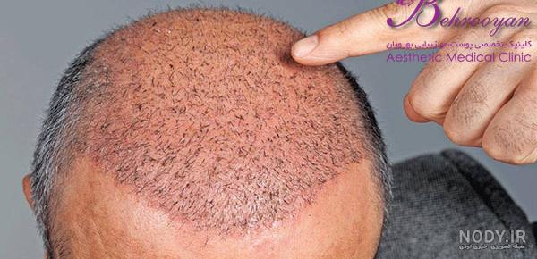 درباره ی کاشت مو:چند نکته مهم در مورد مراحل قبل و بعد کاشت موی سر