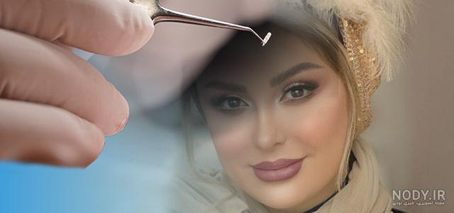 دلمه بعد از کاشت ابرو + راه های پیشگری از ایجاد دلمه دلمه بعد از کاشت ابرو + راه های پیشگری از ایجاد دلمه