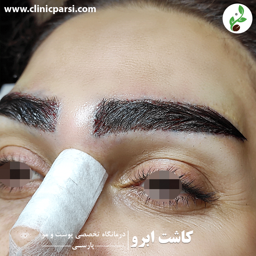 ریزش ابرو بعد از کاشت | دلایل، جلوگیری و درمان - ایران بیوتی ریزش ابرو بعد از کاشت | دلایل، جلوگیری و درمان - ایران بیوتی