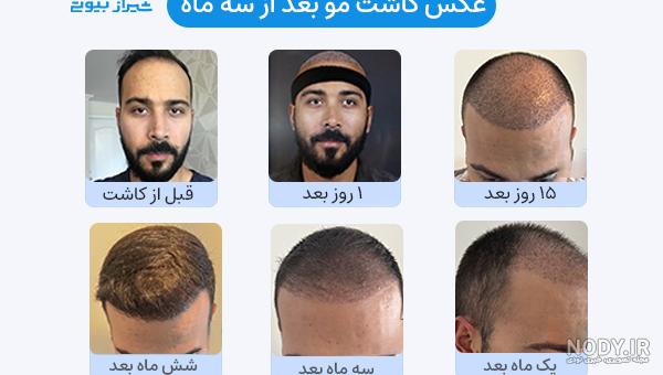 شستشو پس از کاشت مو , "شستشو مو بعد از عمل کاشت مو"