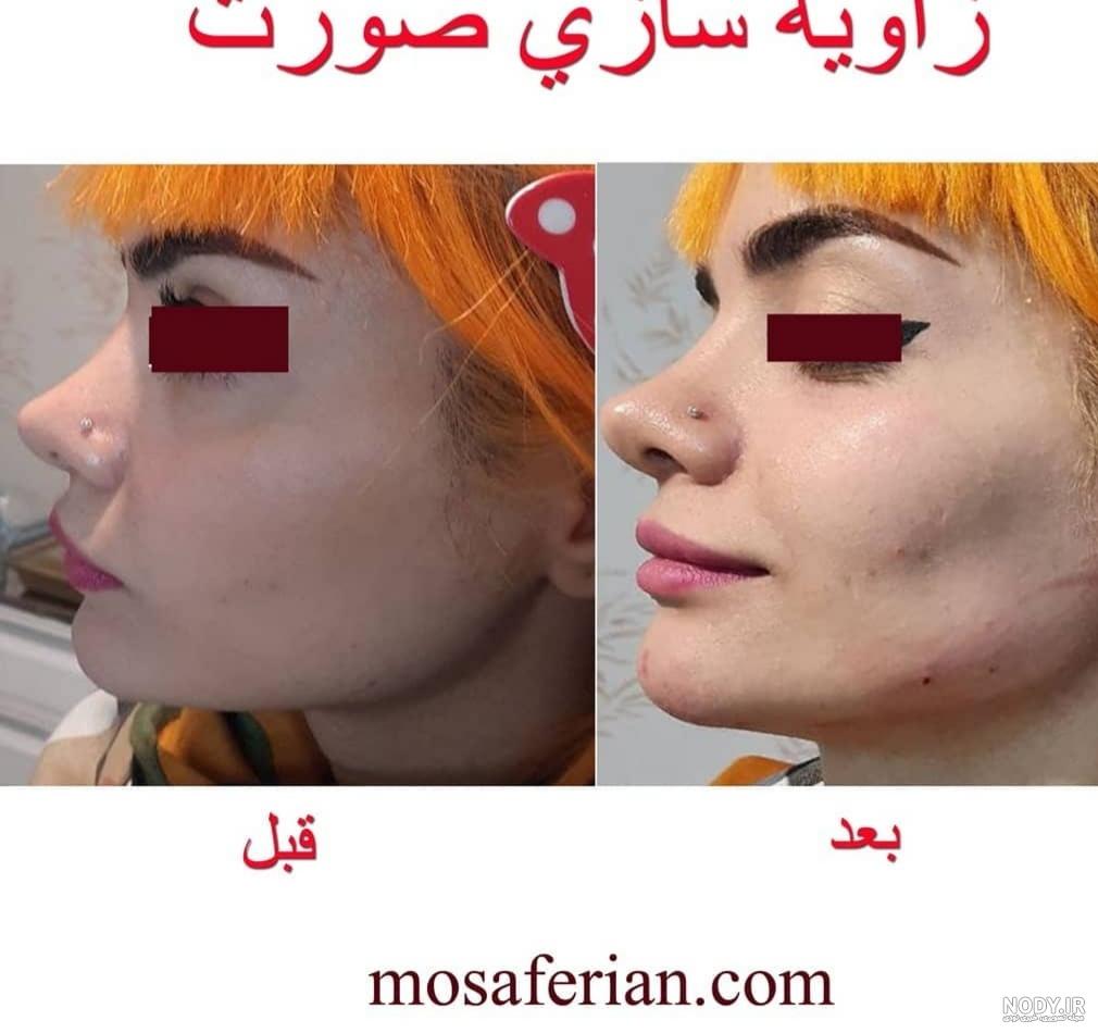 طراحی و کانتورینگ چهره با تزریق فیلر صورت + عکس قبل و بعد - کلینیک ماه تهران طراحی و کانتورینگ چهره با تزریق فیلر صورت + عکس قبل و بعد - کلینیک ماه تهران