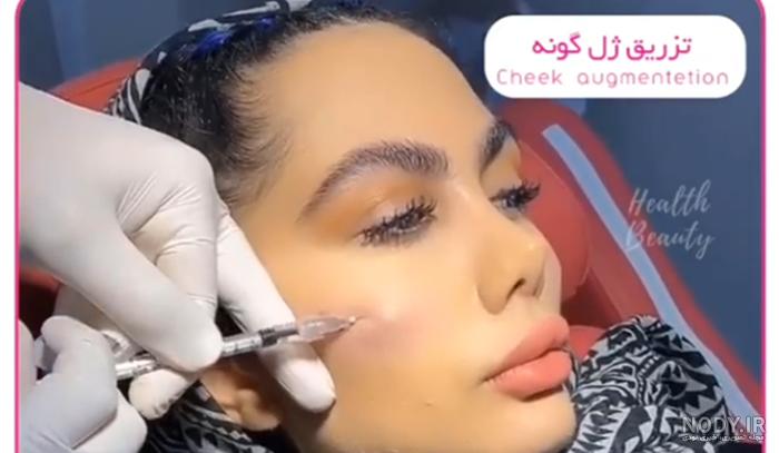 عکس قبل و بعد از تزریق فیلر گونه و چانه - کلینیک زیبایی سام عکس قبل و بعد از تزریق فیلر گونه و چانه - کلینیک زیبایی سام