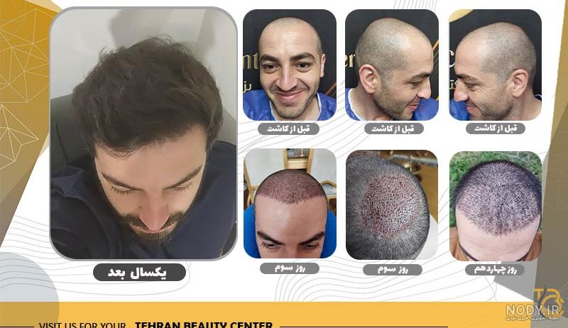 عکس های قبل و بعد از کاشت مو