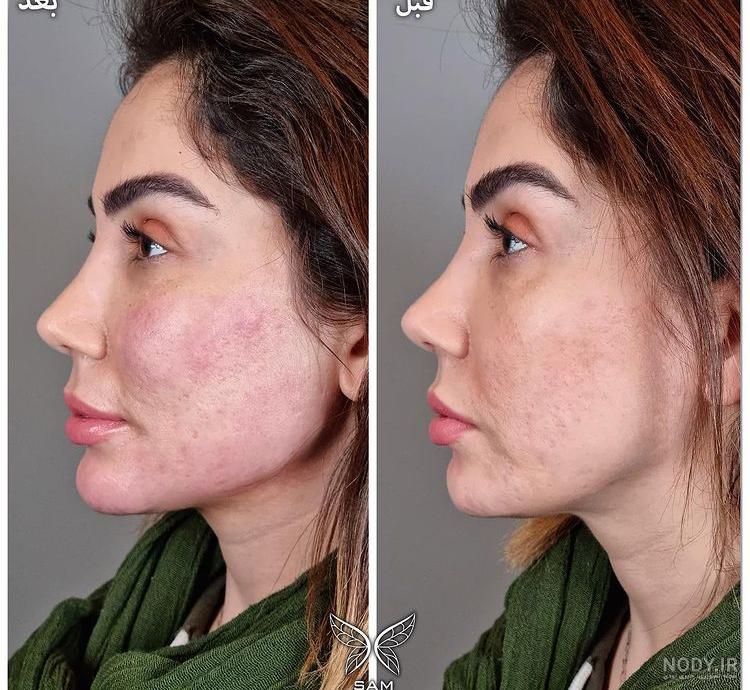 عکس قبل و بعد فیلر گونه و خط خنده - کلینیک زیبایی سام عکس قبل و بعد فیلر گونه و خط خنده - کلینیک زیبایی سام