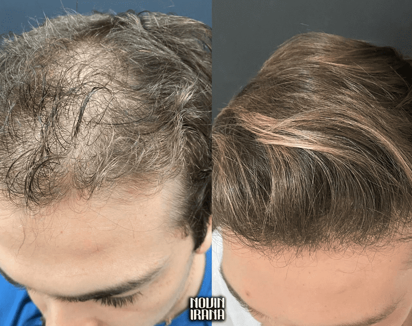عکس موی تازه کاشته شده