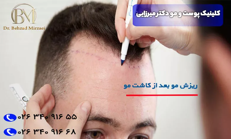 عکس موی کاشته شده