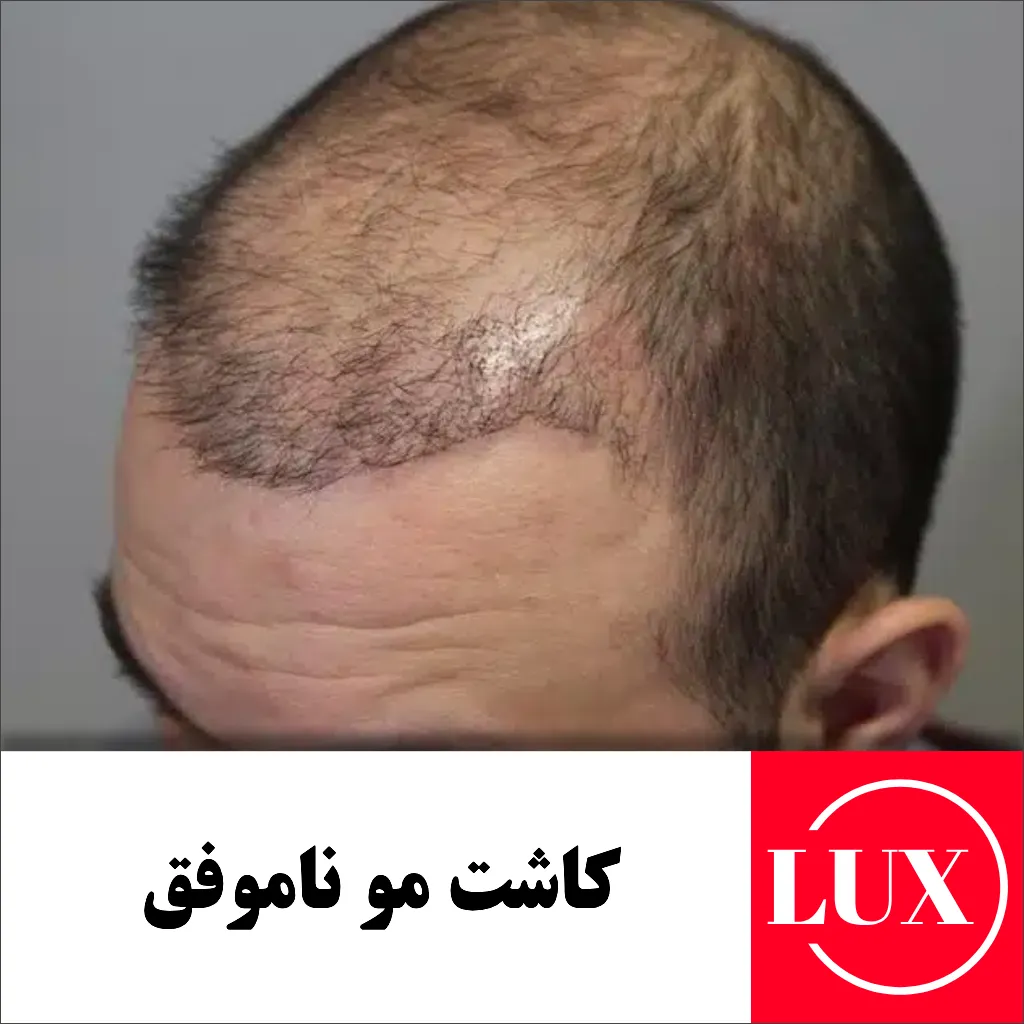 عکس موی کاشته شده بعد از دو ماه