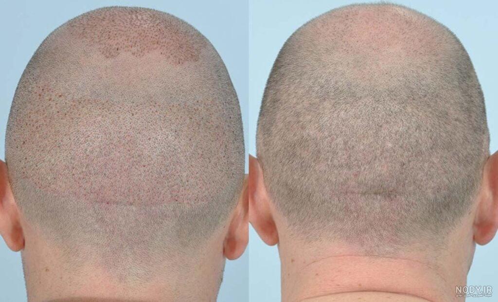 عکس موی کاشته شده بعد از یک ماه