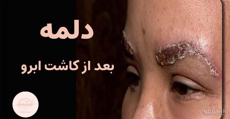 عکس کاشت ابرو عکس کاشت ابرو
