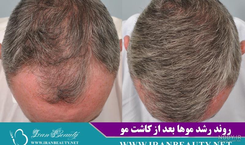عکس کاشت مو بعد از یک ماه - عکس نودی