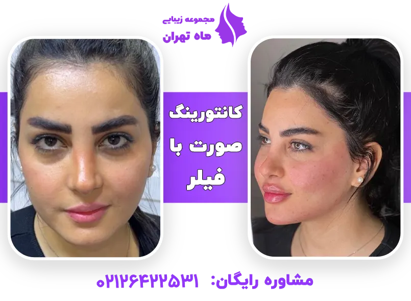 عکس کاشت گونه با ژل عکس کاشت گونه با ژل