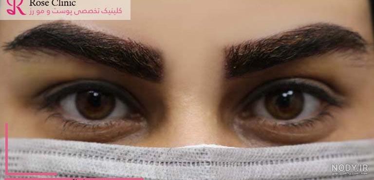 مراقبت های بعد از کاشت ابرو | نکات و دستورالعمل های ویژه مراقبت های بعد از کاشت ابرو | نکات و دستورالعمل های ویژه