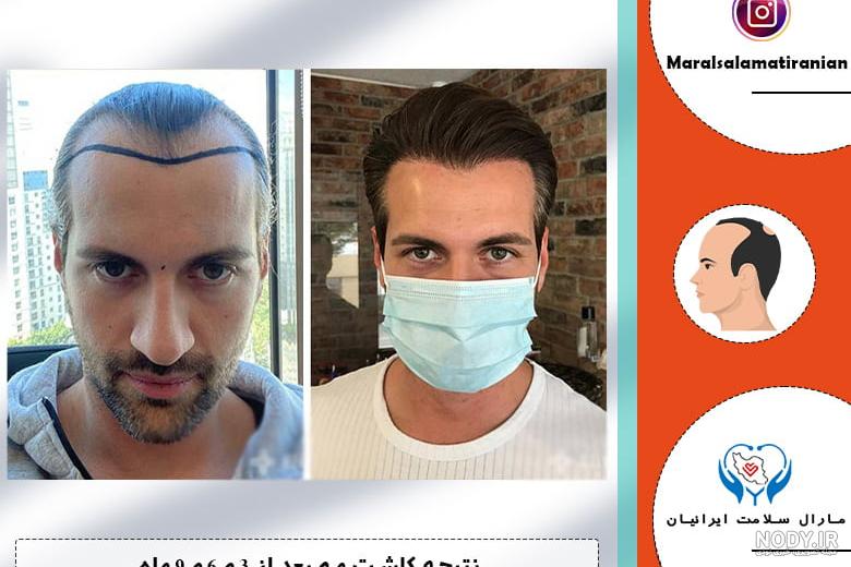مراقبت های بعد از کاشت مو + نکات مهم و اساسی + کلینیک سیماطب