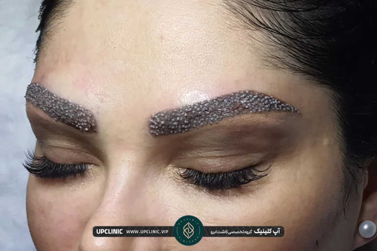 مشاوره رایگان کاشت ابرو - مرکز تخصصی کاشت مو نیمرخ مشاوره رایگان کاشت ابرو - مرکز تخصصی کاشت مو نیمرخ